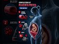 Complications of Placenta Previa | Dangerous Pregnancy Bleeding Explained