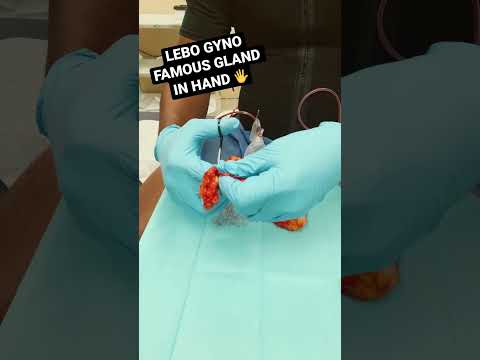 GYNECOMASTIA: LEBO GYNO FAMOUS GLAND IN HAND 🖐