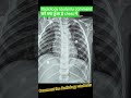 doctor भी नहीं बता पाएंगे कि क्या हुआ है इस बच्चे के chest में, radiology students comment the....