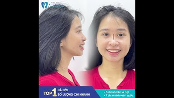 MẶT LỆCH - RĂNG HÔ - MẤT TỰ TIN KHI CƯỜI, ATHENA CHỈNH SỬA NHƯ THẾ NÀO ?