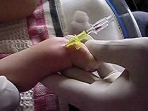 Dr Raichur's Method of Neonatal Radial Artery Cannulation  in action1