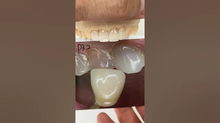 Monet Pure Zirconia Incisors@EnvisiontecMain #envisiontec #dental #teeth #smile #lsk121shorts