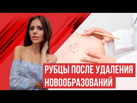 Лечение рубцов после удаления новообразований