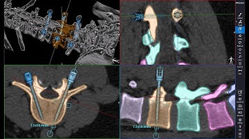 AI Spine Segmentation with advanced Glass effect visualization