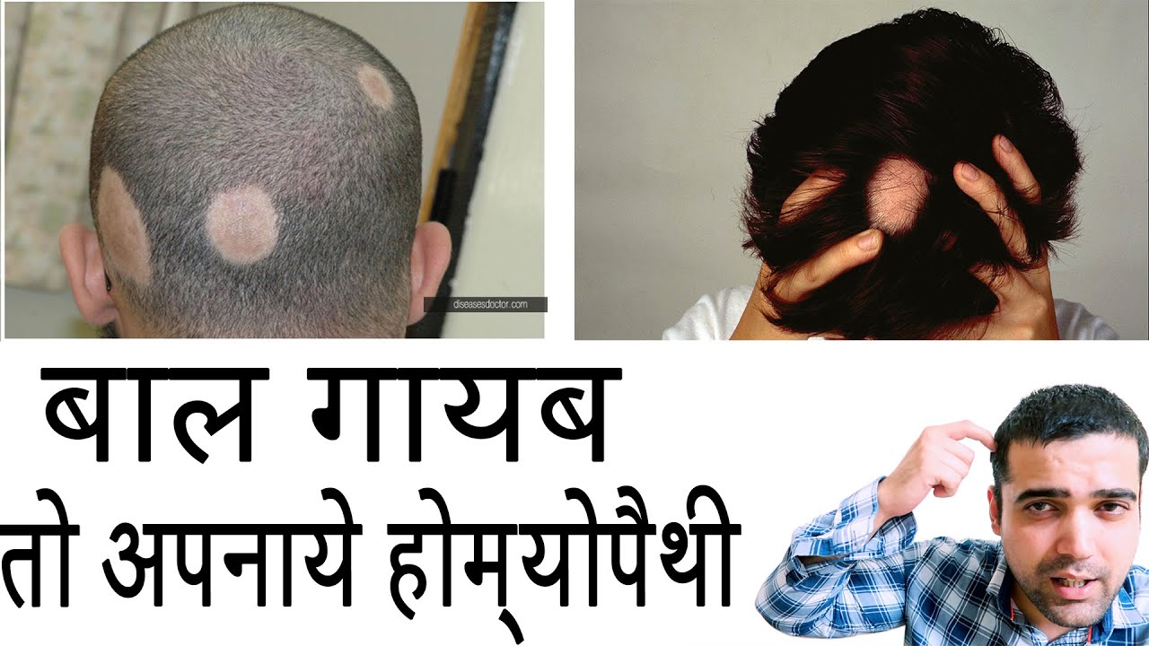 1 Medicine for Hair Regrowth after Alopecia Areata HOMEOPATHIC