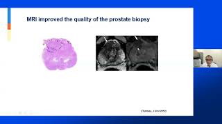 What's New in Active Surveillance for Prostate Cancer