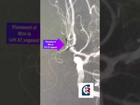 Brain Aneurysm #flowdiverter
