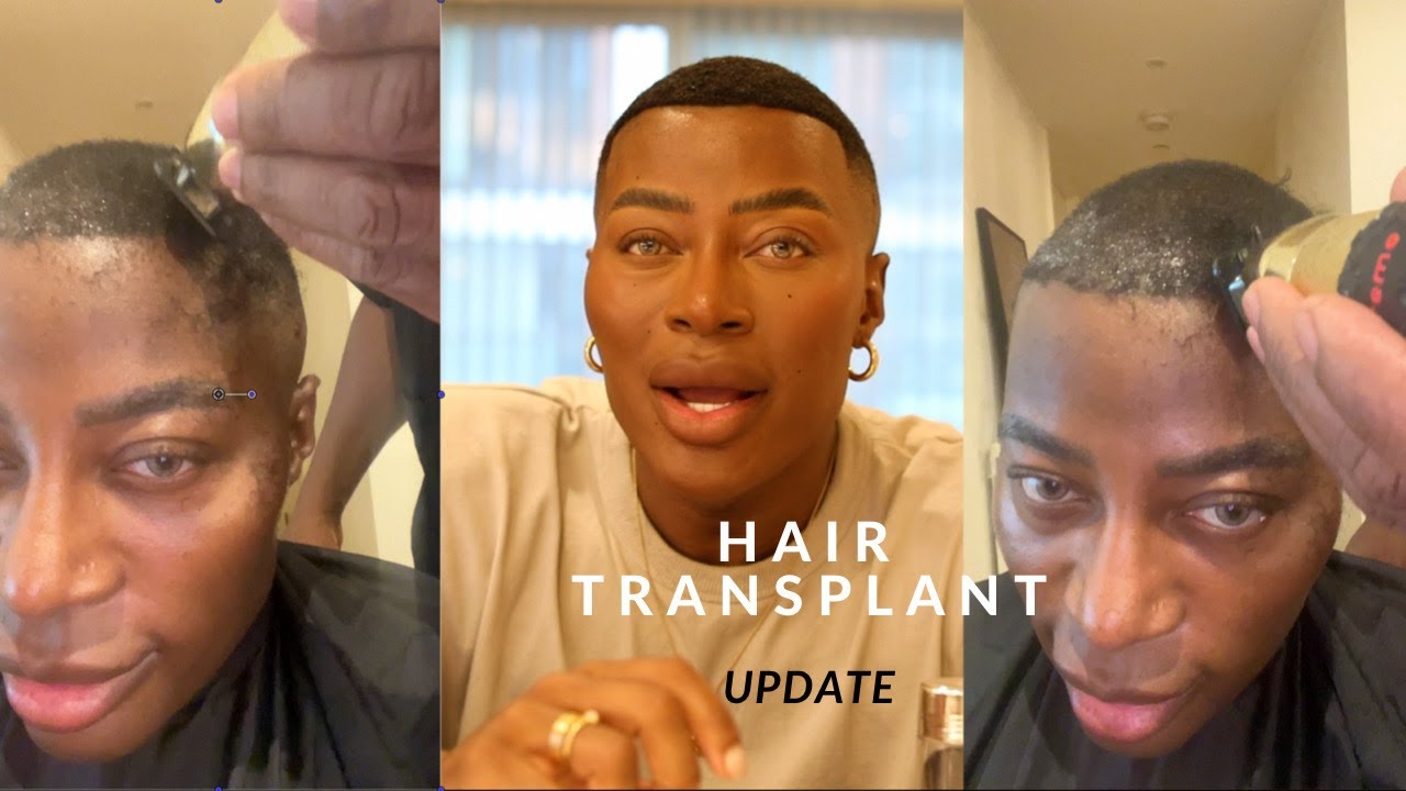 7/8 MONTH HAIR TRANSPLANT UPDATE! ASLI TARCAN + NEW HAIR STYLE! |ThePlasticBoy