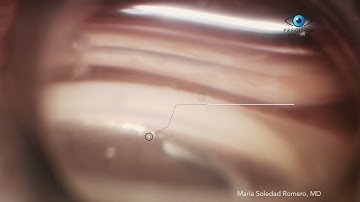 MIGS - Hydrus Microstent procedure