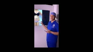 دكتور حسام تحسين : شد البطن عملية تحسين فور دي Tahseen4D Tummy tuck