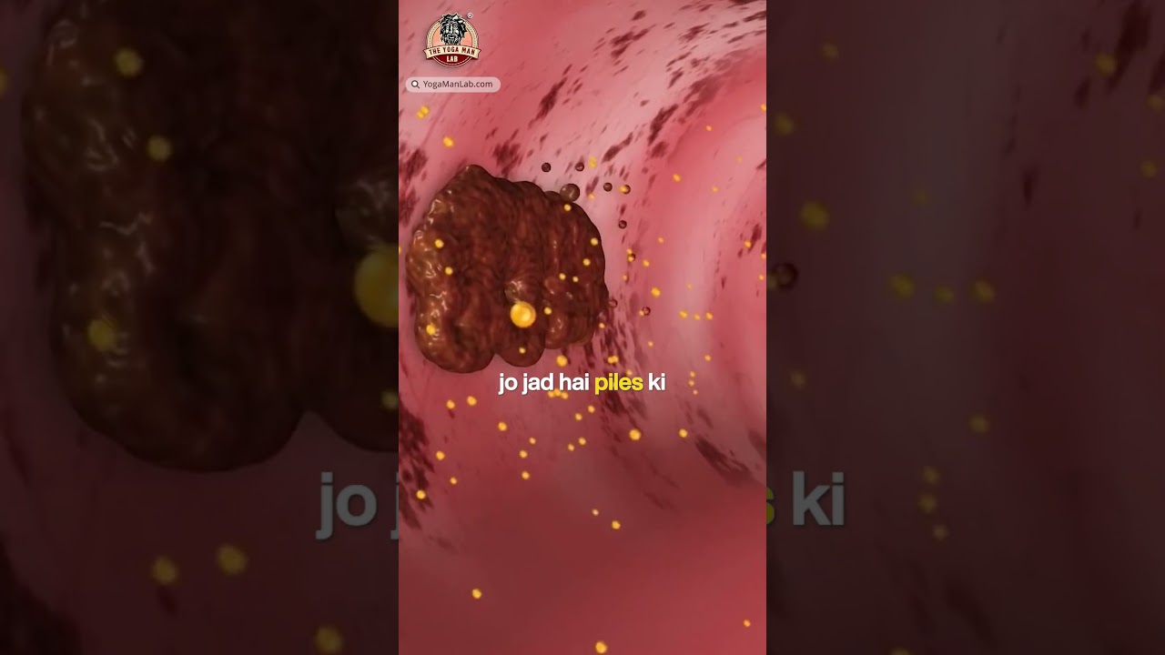 Preventing Grade 3 Piles Naturally | PILES MATRIX