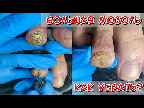 Огромная мозоль / мозоль на пальце ноги / Мозоль как убрать