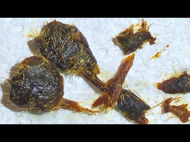 143 - Dense Matted Lodged Ear Wax Removed using WAXscope®️ class=