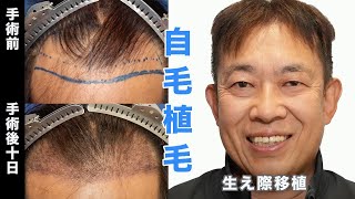 10 Days After Hair Transplant] Interview with a patient who