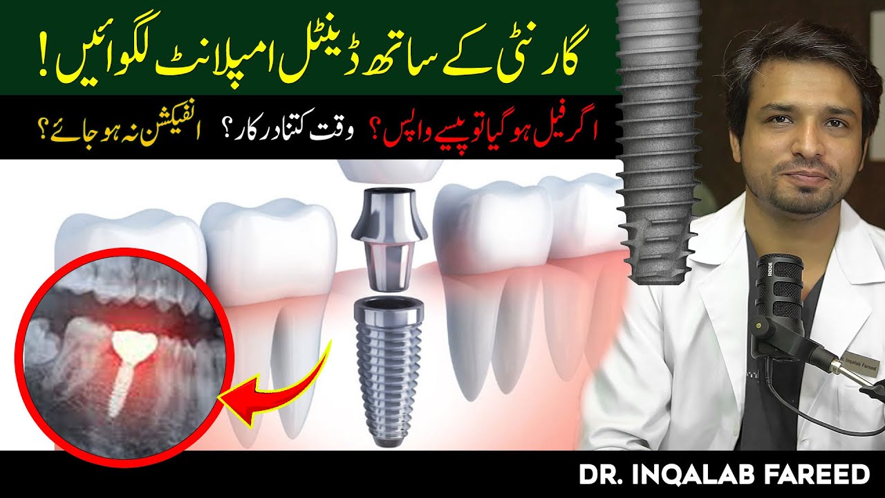 Лучшее предложение по имплантации зубов в Пакистане с полной гарантией!