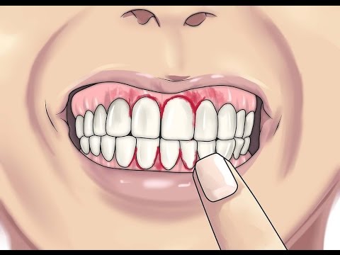 beautycon 😷 Home remedies for toothache that amazed my dentist when i told him