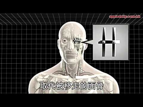英男割腫瘤留駭人洞口　新技術助重生 3D打印半邊人造面皮 - 20130402 - 蘋果日報