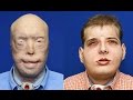 US Firefighter Gets A New Face Of Another Person After Surgery