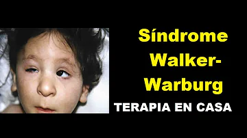 ¿Qué es el síndrome de Walker-Warburg?