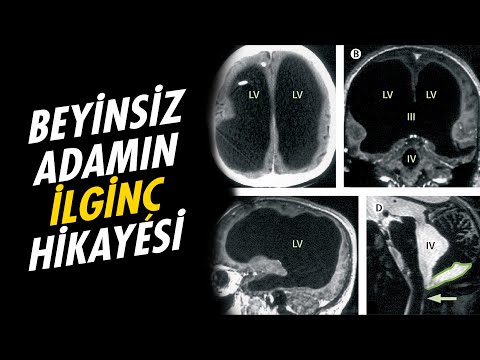 Video: Bir yıl sabahları ballı limonlu su içtim. Bundan ne çıktı?