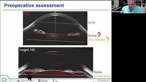 Dr. Dan Reinstein and ArcScan: Unique diagnostic applications in corneal and ICL refractive surgery