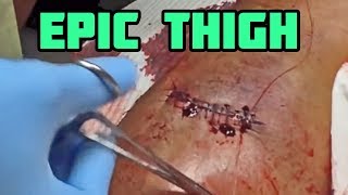 Thigh Operation - Epic Journey to Recovery