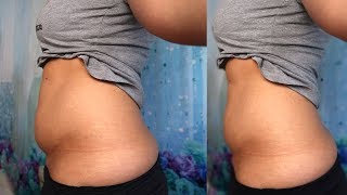 Fett weg Spritze Bauch - Hilft es wirklich? | Selbsttest + Vorher Nachher Vergleich