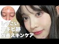 【ニキビ跡】しつこい色素沈着を改善するスキンケア！