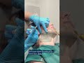 Masseter Botox for Jaw Pain, TMJ &amp; Facial Slimming 👀 | Patient Experience