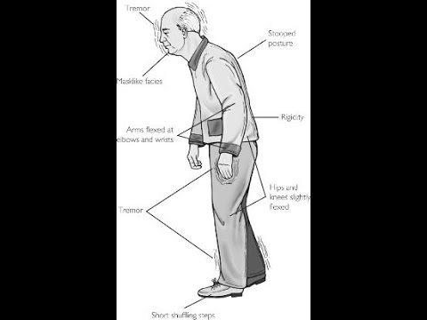 Extrapyramidal علامات