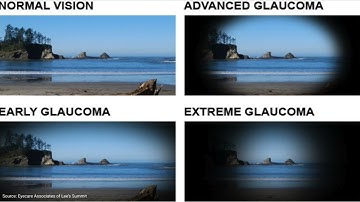 Glaucoma | An Introduction for Patients