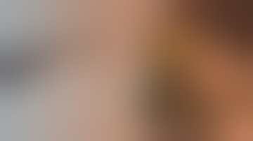 remOVE System | Clip removal after full thickness resection in sigma