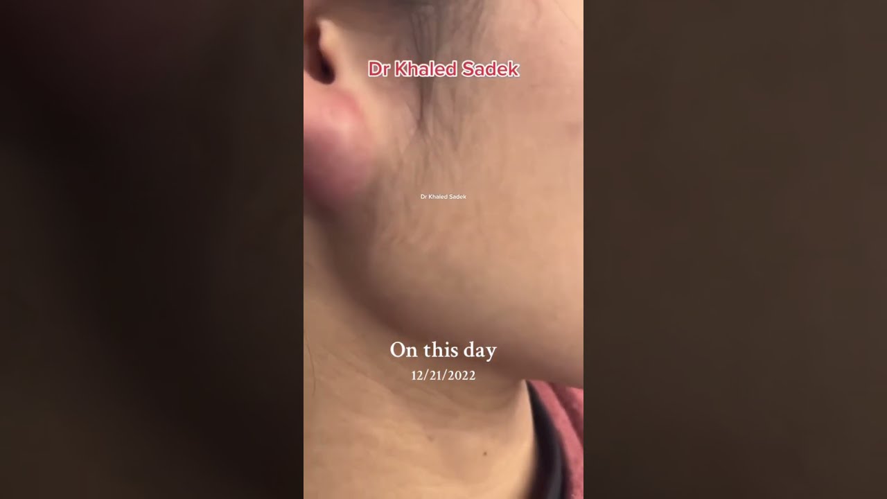 Massive Ear Cyst Skincare Blackheadremoval Pimple Dr Khaled Sadek