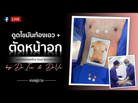 รีวิวผ่าตัดหน้าอก ผู้ชายมีนม (Gynecomastia) พร้อมดูดไขมันหน้าอก