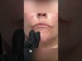 How to judge lip projection correctly