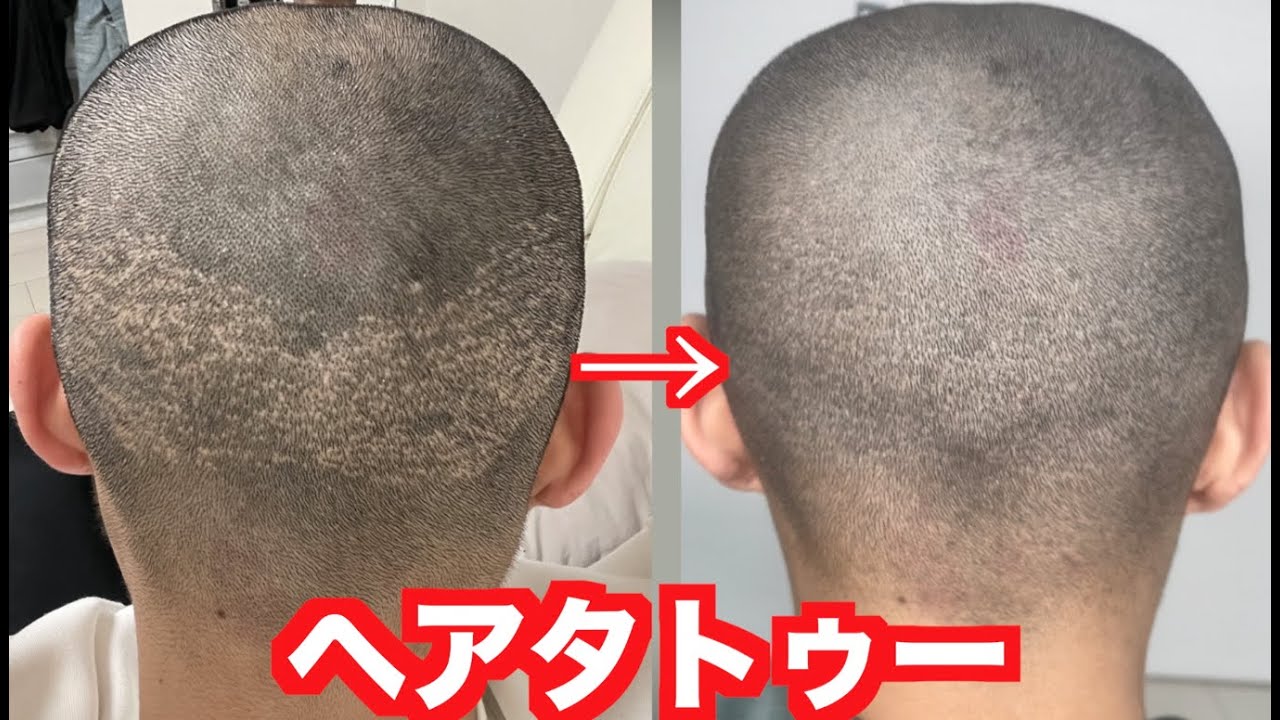 ヘアタトゥーで自毛植毛の傷跡消してみた【完成形】 YouTube