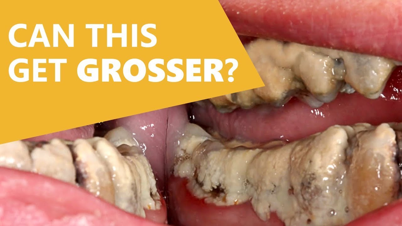 He Didn't Brush His Teeth for 20 Years! YouTube