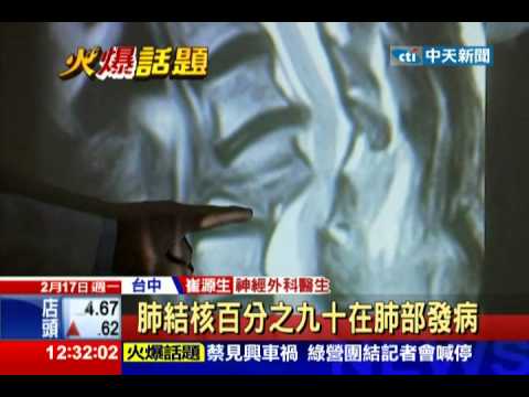 中天新聞》打個噴嚏頸椎骨折 「肺結核菌」蝕骨！