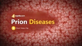 Prion Diseases | Neurology Medicine Animation | V-Learning | sqadia.com
