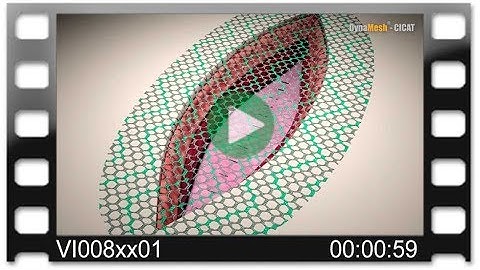 DynaMesh®-CICAT - Animation: Retromuscular Alloplasty - Incisional Hernia Repair