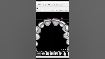 What you DONT see Behind Your Invisalign 🤯 #invisalign #invisalignsmile #invisalignjourney #dentist