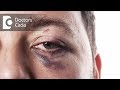 What is Black Eye & its treatment? - Dr. Sriram Ramalingam