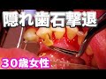 tartar removal 【30歳女性 】隠れ歯石撃退！歯茎から湧き出る歯石たち・・・