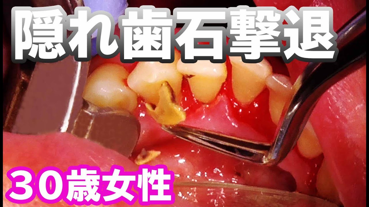 tartar removal 【30歳女性 】隠れ歯石撃退！歯茎から湧き出る歯石たち・・・😱