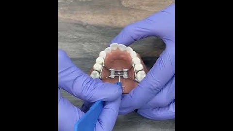 Pro Tip!: How to turn a palatal expander