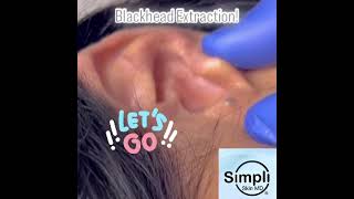 Blackhead Extraction