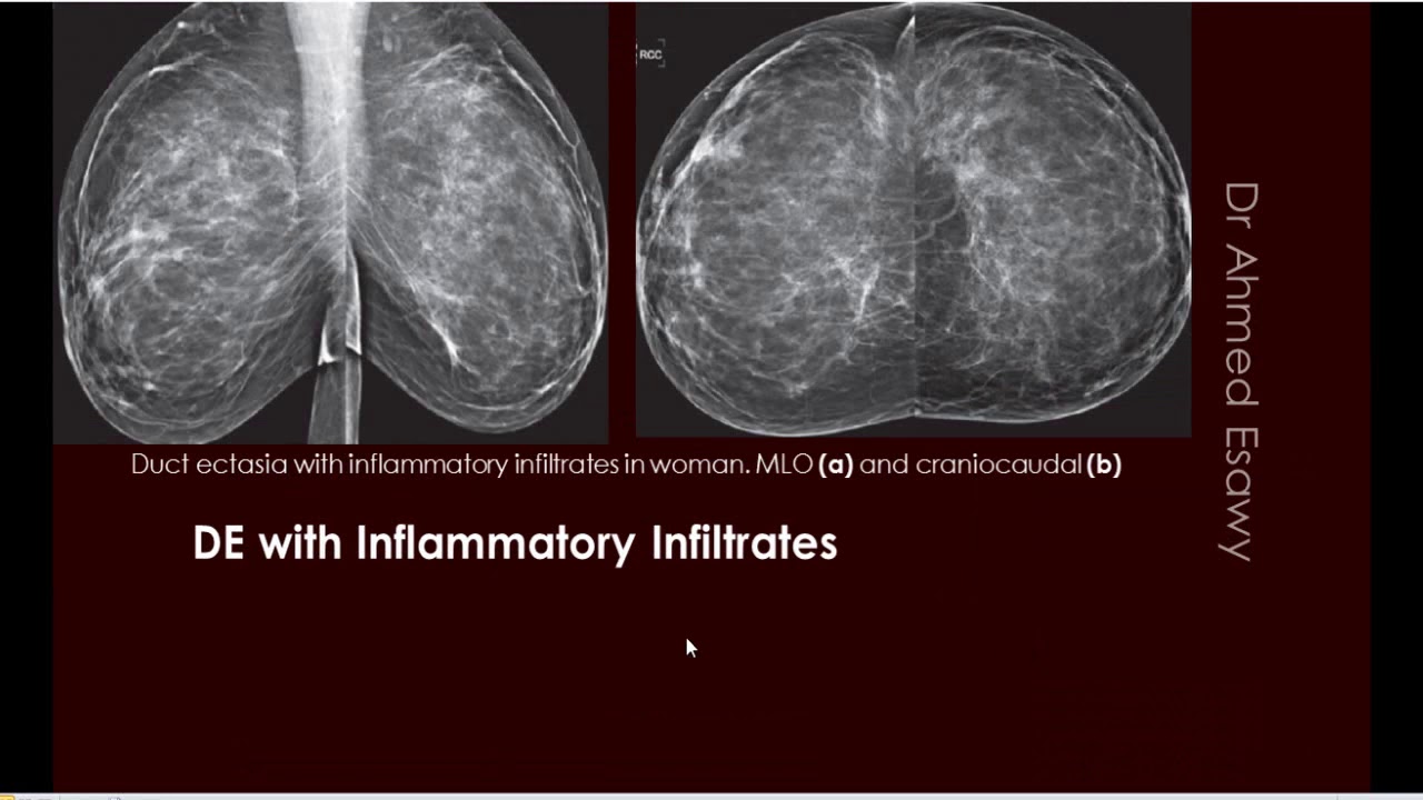 5 sonomammography ACR BIRAD breast benign vs malignant mammary duct ectasia  MDE 