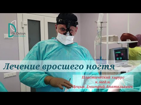 Видео: Хирургия вросшего ногтя: процедура и уход