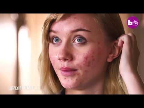 როგორ ვუმკურნალოთ აკნეს