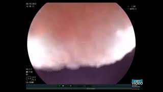 An Upper Endoscopy Egd Is A Procedure That Examines The Upper Gastrointestinal Gi Tract.